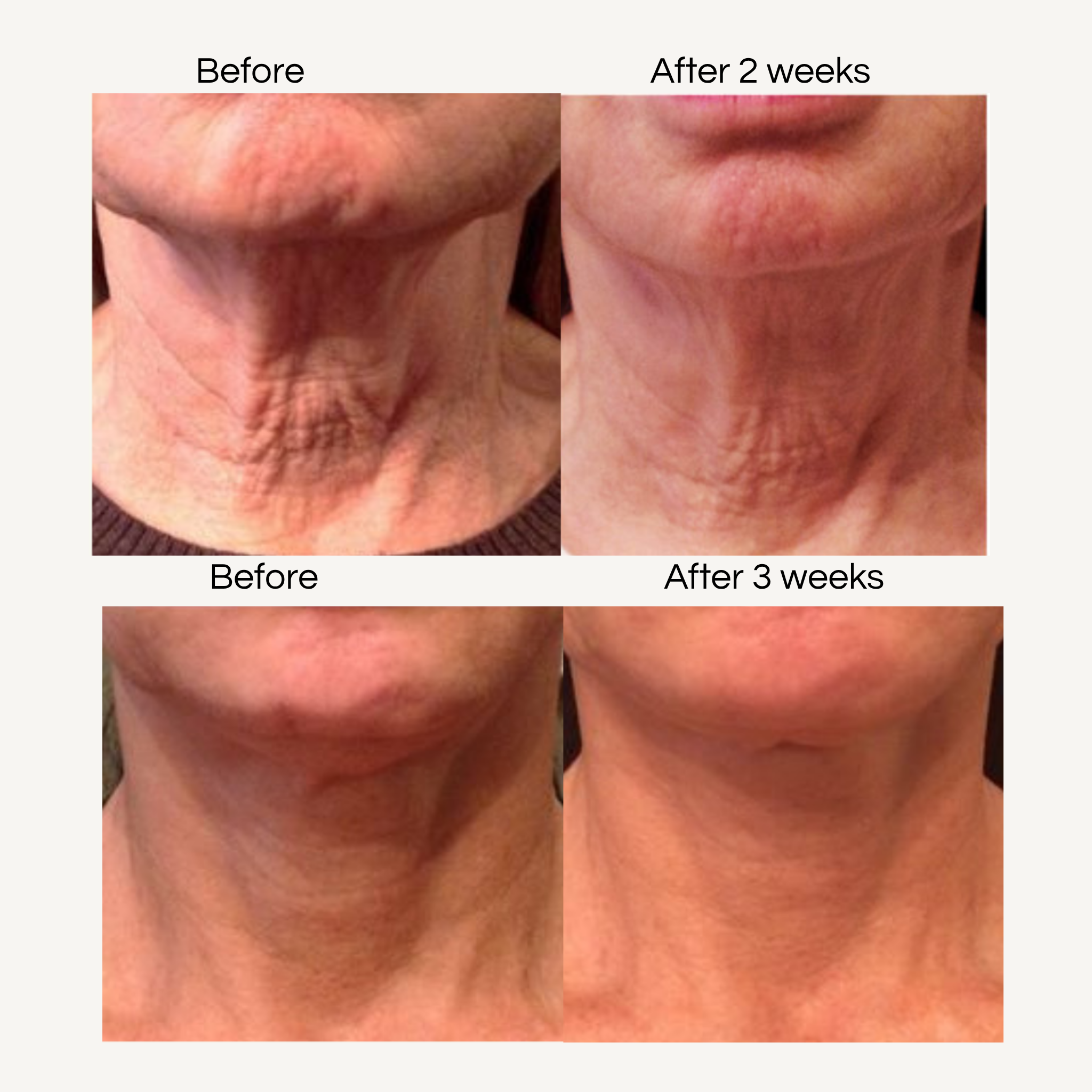 REBEL X neck cream before and after clinical study comparison showing dramatic improvement in neck wrinkles, crepey skin texture, and firmness at 2 and 3 week intervals for mature skin anti-aging results