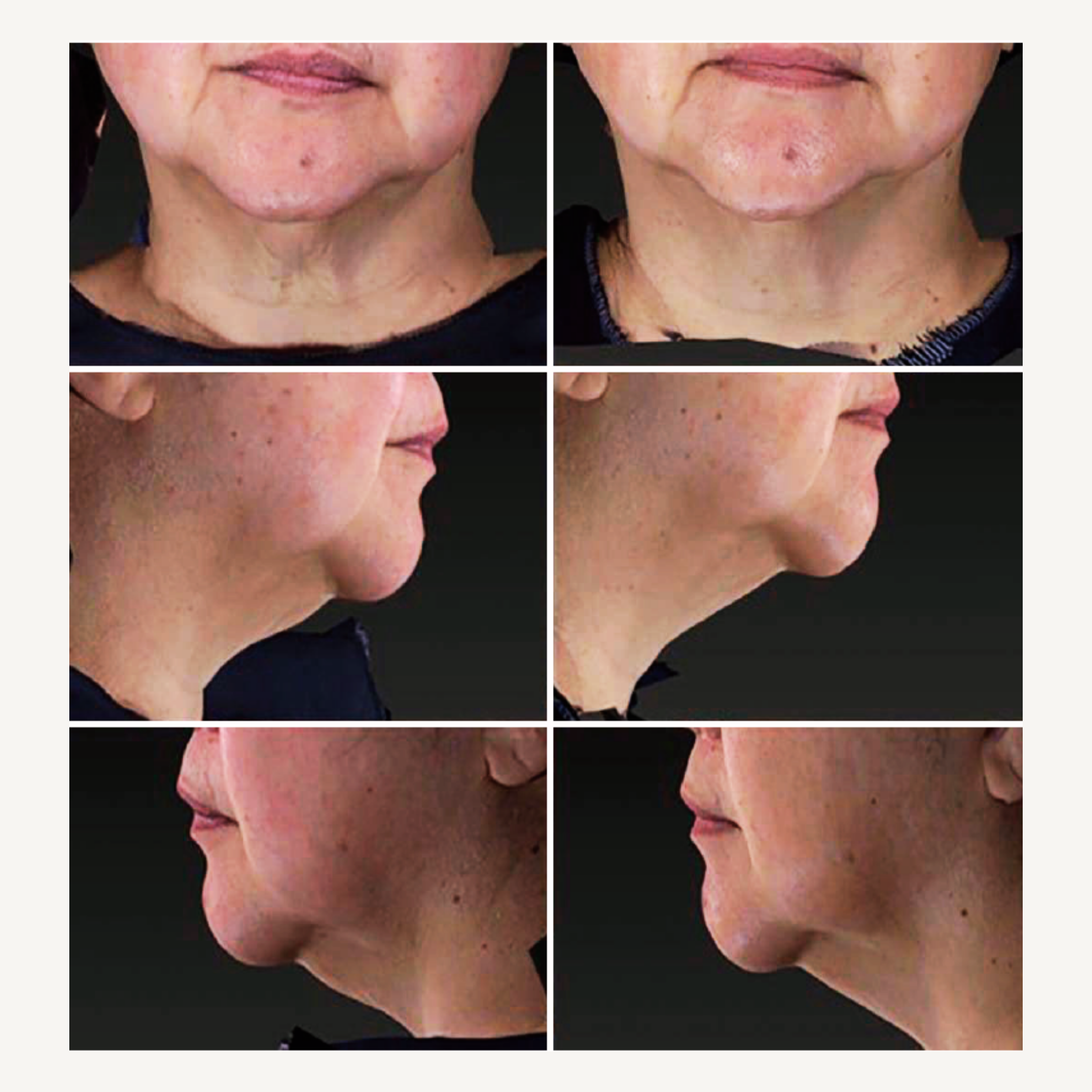 REBEL X neck cream clinical study results showing before and after photos from multiple angles demonstrating improved jawline definition, reduced neck sagging, and enhanced skin firmness in mature women