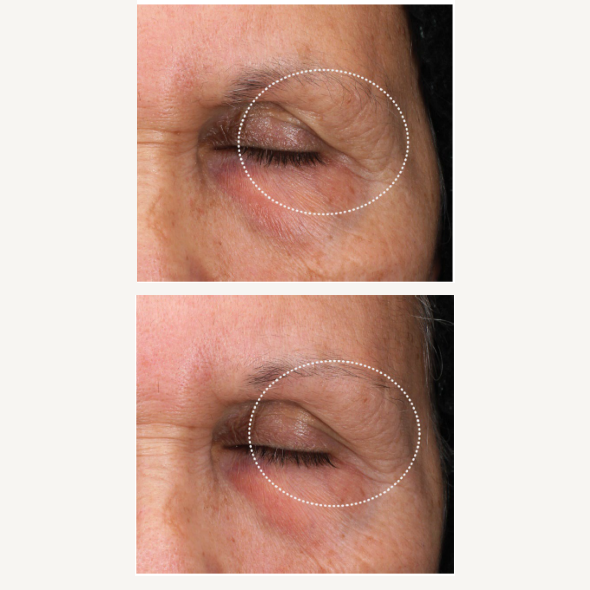 REBEL X EyeLift eye cream before and after clinical study comparison showing close-up of mature woman's eye area with dramatically reduced crow's feet, improved eyelid firmness, diminished fine lines, and enhanced skin texture demonstrating PRD-TECH peptide results