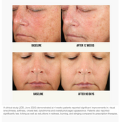 Before and after comparison of facial skin texture with text indicating time periods and study details.