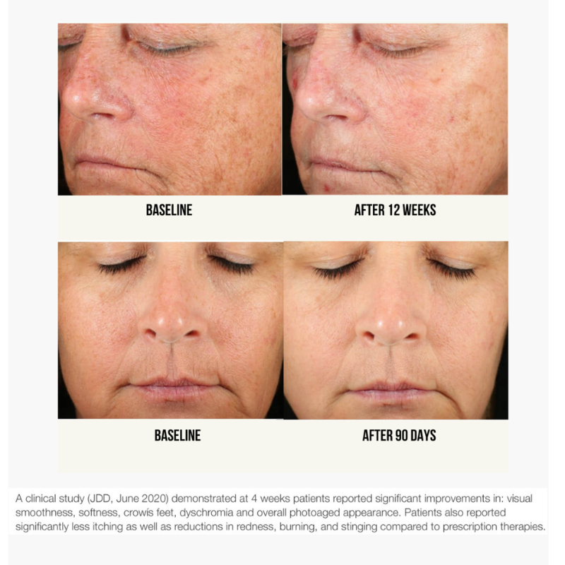 Before and after comparison of facial skin texture with text indicating time periods and study details.